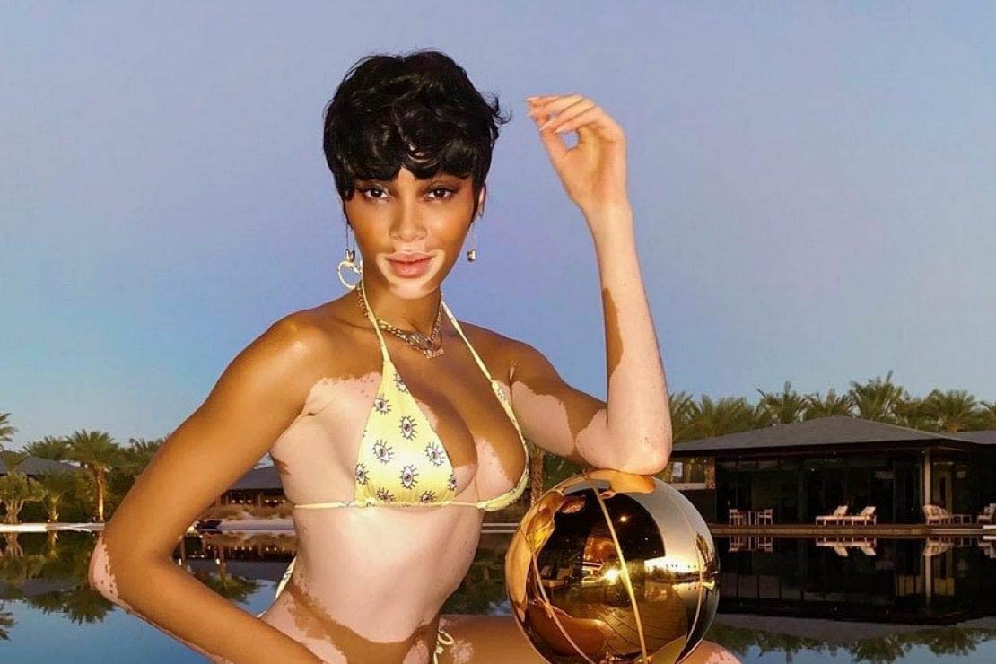 Winnie Harlow Winnie Harlow